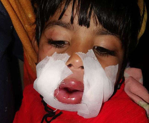 3 साल की बच्ची के मुंह में फोड़ा बम
